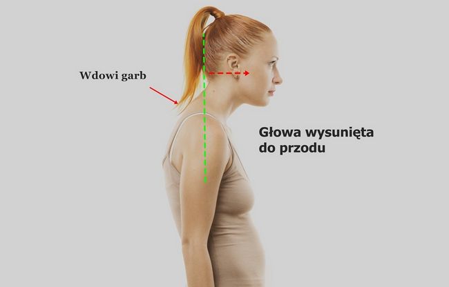 Wdowi garb – leczenie, objawy, ćwiczenia, rehabilitacja