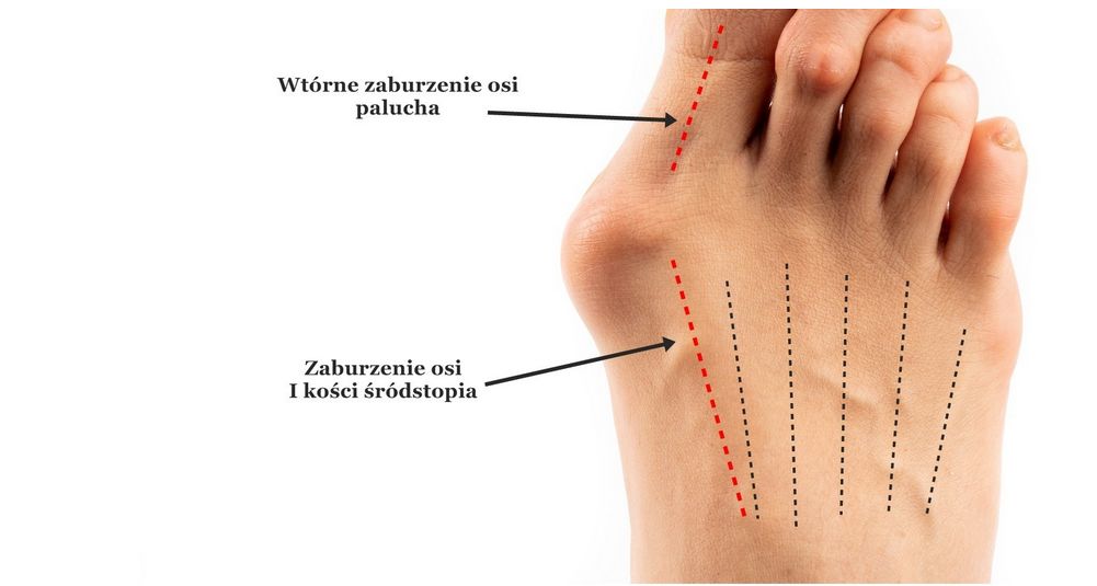 Haluksy (halluks valgus, paluch koślawy) – leczenie, orteza, zabieg, rehabilitacja