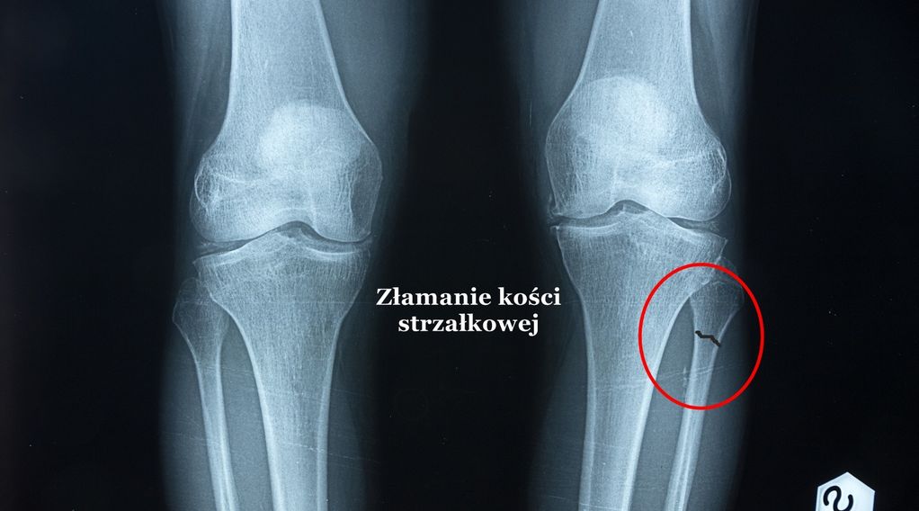 Złamanie, pęknięcie kości strzałkowej – objawy, leczenie, operacja, rehabilitacja