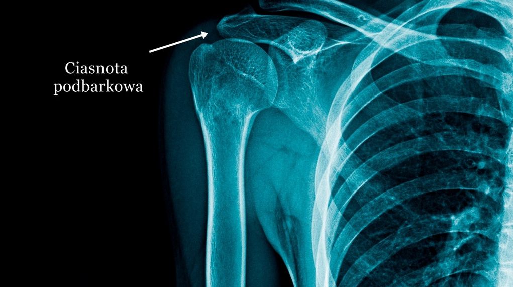 Zespół ciasnoty podbarkowej (cieśń, ciasnota podbarkowa) ? objawy, ćwiczenia, operacja