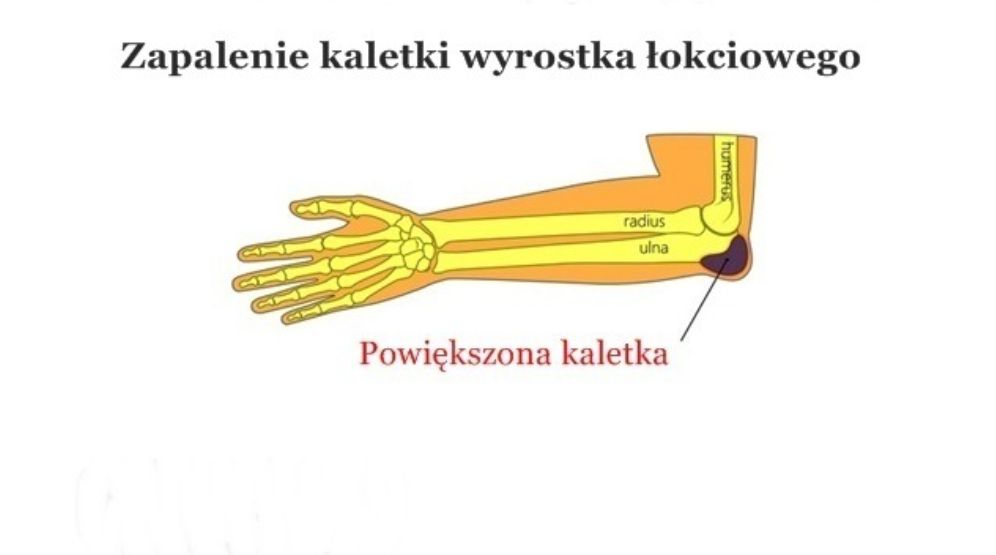 Zapalenie kaletki maziowej łokcia (wyrostka łokciowego) ? objawy, leczenie, rehabilitacja