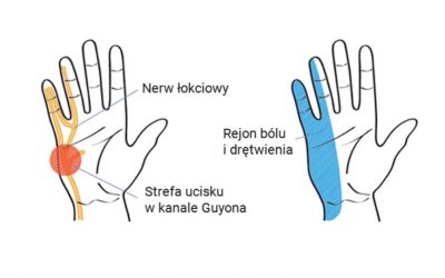 Zespół kanału (cieśń) Guyona – objawy, leczenie, operacja, rehabilitacja