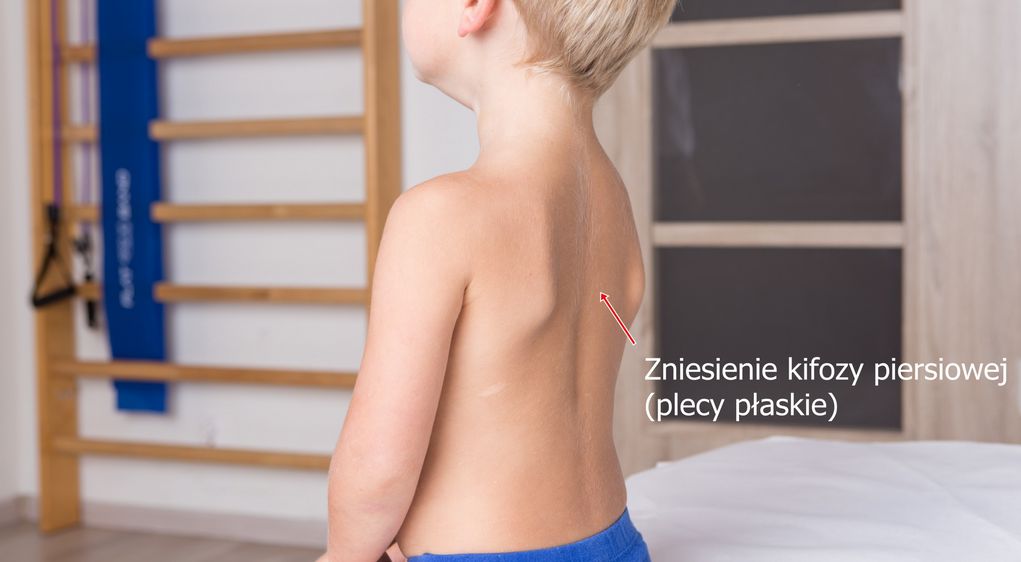 Plecy płaskie u dzieci – ćwiczenia, rehabilitacja